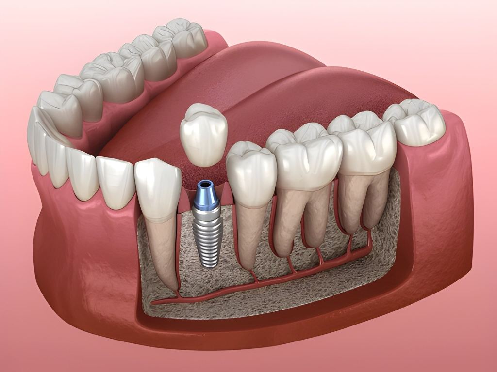 Top 10 Reasons Why Dental Implants Are the Best Tooth Replacement Option