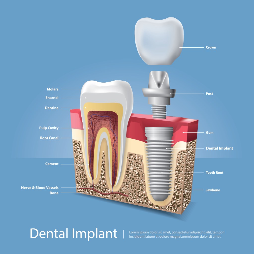Dental Implant